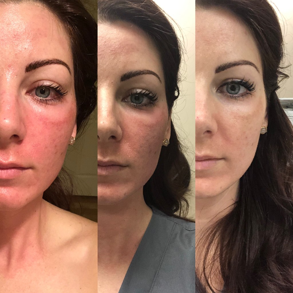 Topical reaction to wheat exposure in celiac patient.